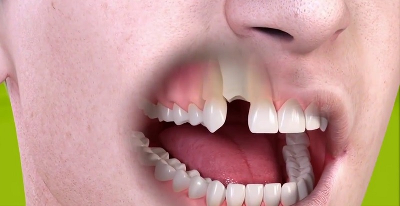 Mất răng là một trong những ảnh hưởng nghiêm trọng do ép xe gây ra
