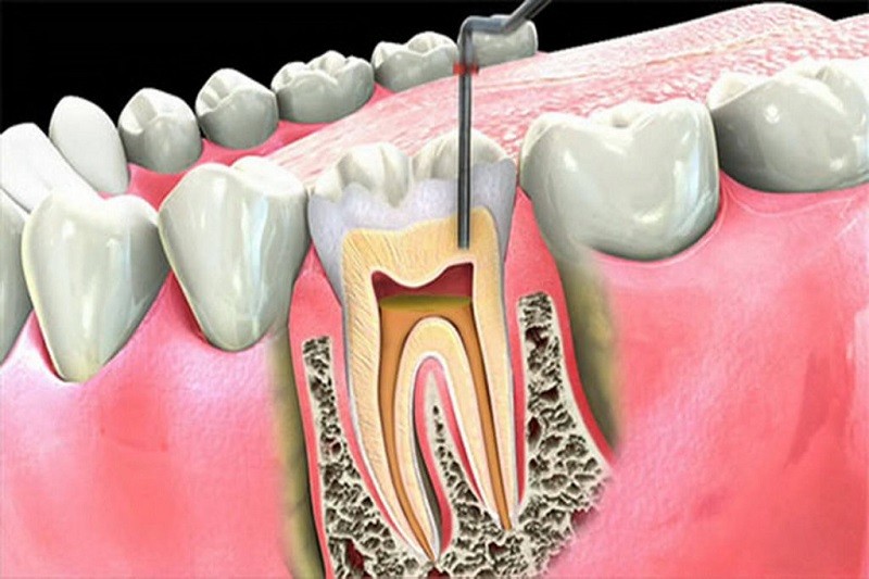 Điều trị tủy răng để loại bỏ vi khuẩn