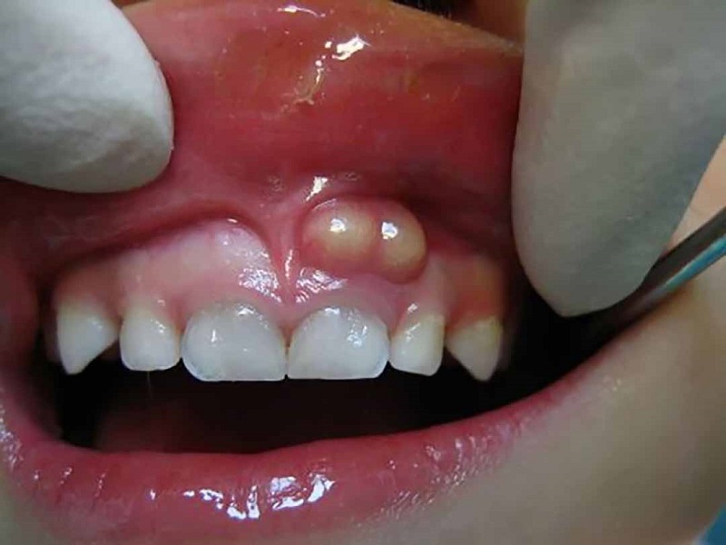 Áp xe răng là một dạng nhiễm trùng do sâu răng, nứt răng hoặc các bệnh lý khác về nướu gây ra