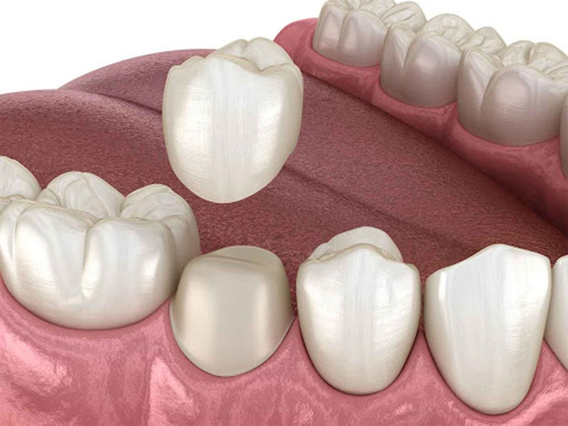 Đối tượng nên bọc răng gồm những ai bị mẻ răng, sứt răng,...