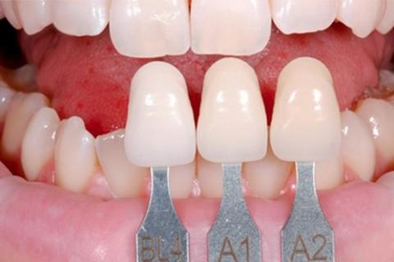 Tùy tình trạng hô mà nên bọc răng sứ cho phù hợp