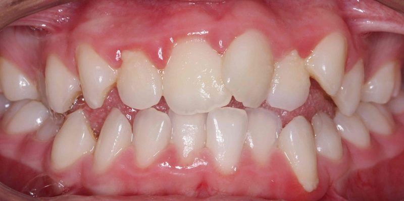 Tình trạng răng mọc lệch lạc, lộn xộn gây mất thẩm mỹ cho hàm răng