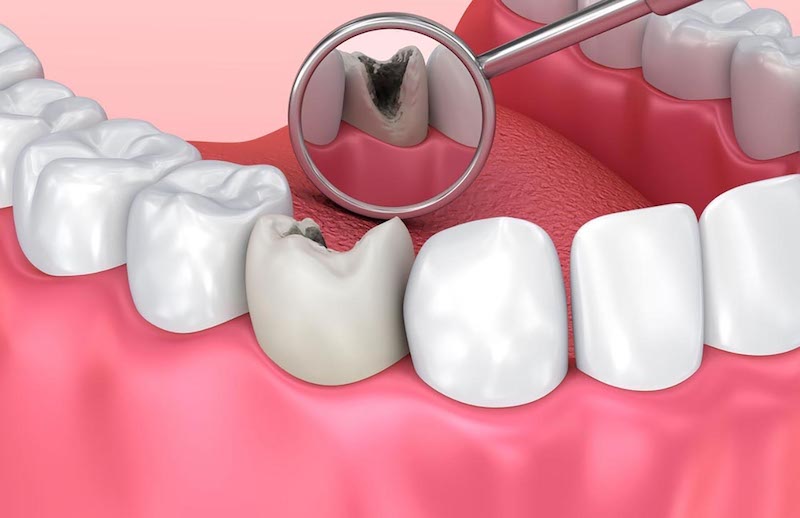 Bọc răng sứ cho răng sâu được thực hiện bằng cách dùng một mão sứ bao bọc bên ngoài răng sâu