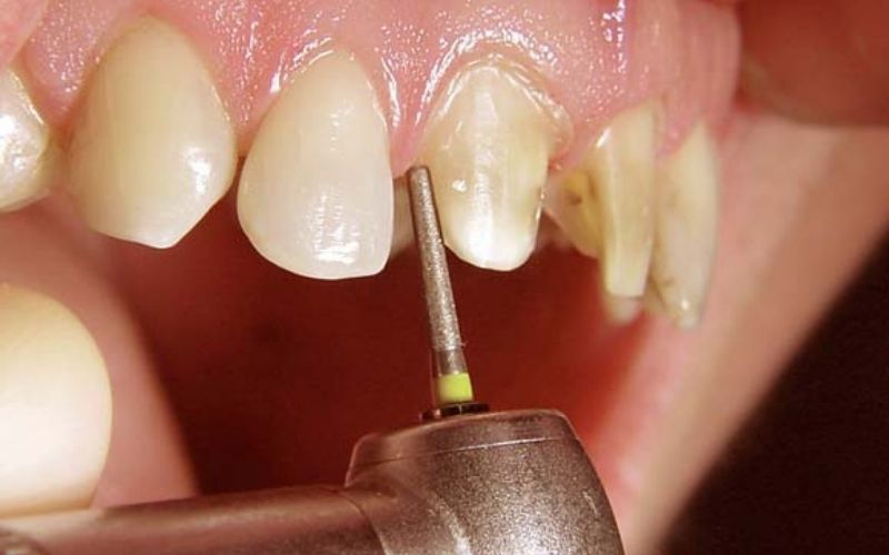 Có rất nhiều lý do từ chủ quan đến khách quan khiến việc bọc răng sứ bị đau