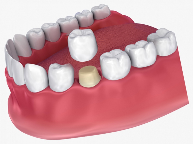 Bọc răng sứ nguyên hàm là giải pháp nha khoa thẩm mỹ phổ biến