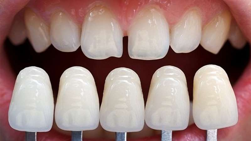 Bọc sứ răng cửa là sử dụng chiếc răng có hình dáng như răng thật để bọc lên chiếc răng cửa bị khiếm khuyết.