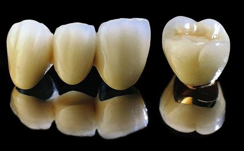 Răng sứ kim loại có chi phí rẻ phù hợp với túi tiền tuy nhiên có thể gây ra kích ứng.