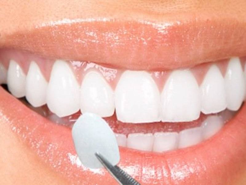 Quy trình bọc sứ răng cửa cần được thực hiện bởi bác sĩ có chuyên môn và tay nghề cao.