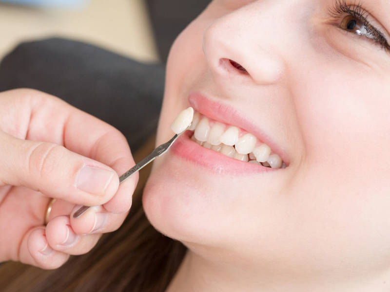 Bọc răng sứ cho răng khểnh sở hữu những ưu điểm vượt trội những cũng có những khuyết điểm cần phải cân nhắc.