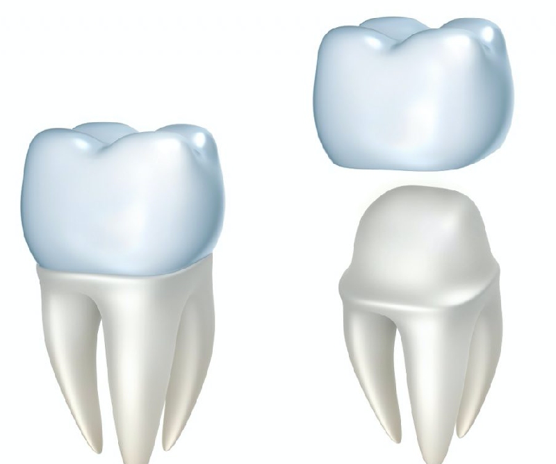 Răng sứ được cố định trên khung hàm