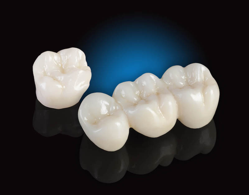 Răng sứ E-Max có điểm mạnh về chất liệu và thời gian sử dụng