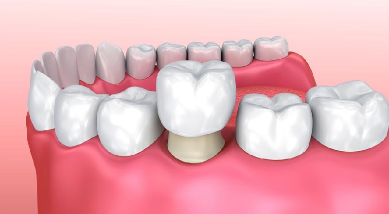 Quy trình bọc răng sứ buộc phải trải qua bước mài cùi răng