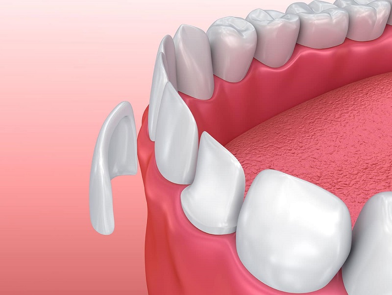 Răng sứ veneer là một công cụ được ứng dụng phổ biến trong nha khoa thẩm mỹ