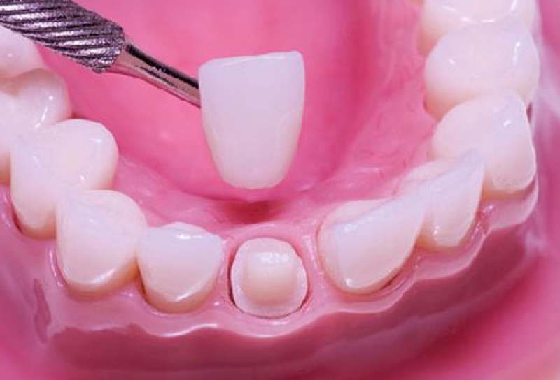 Quy trình bọc răng sứ cần được thực hiện một cách tỉ mỉ và cẩn thận.