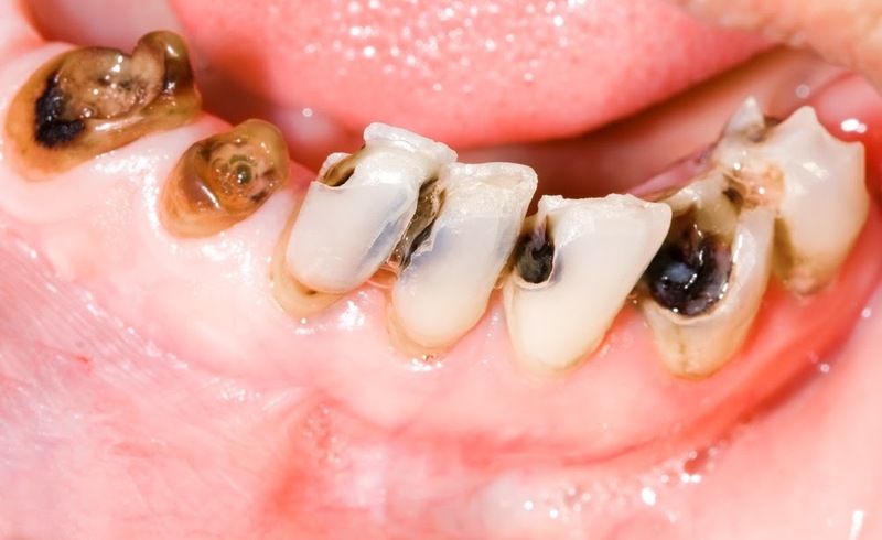 Răng sâu do sự tấn công của vi khuẩn vào mảng bám