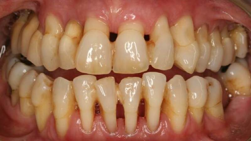 Hình ảnh bị sâu răng ở vị trí tiếp xúc giữa 2 răng