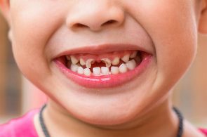 Sún răng là bệnh lý ở đường răng miệng thường gặp ở trẻ nhỏ