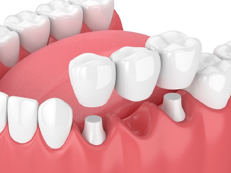 Phương pháp trồng răng sứ phục hình cố định (Cầu răng)