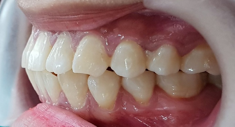  Trường hợp răng bị hô móm nghiêm trọng nên niềng răng