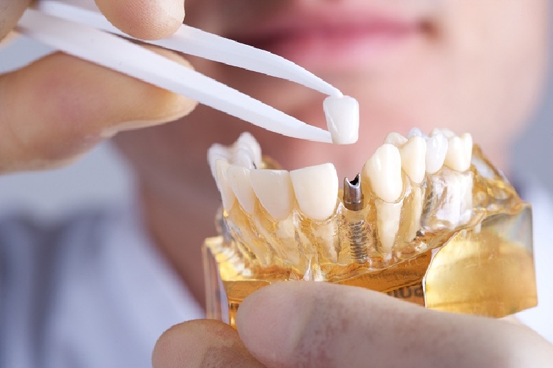 Phương pháp trồng răng sứ cấy ghép Implant