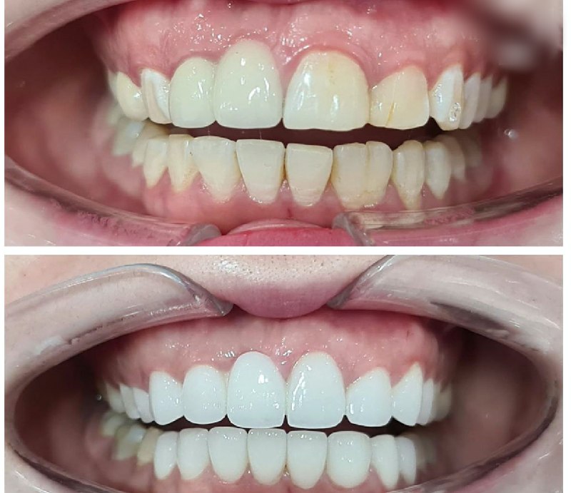 Hình ảnh trước và sau khi bọc răng sứ
