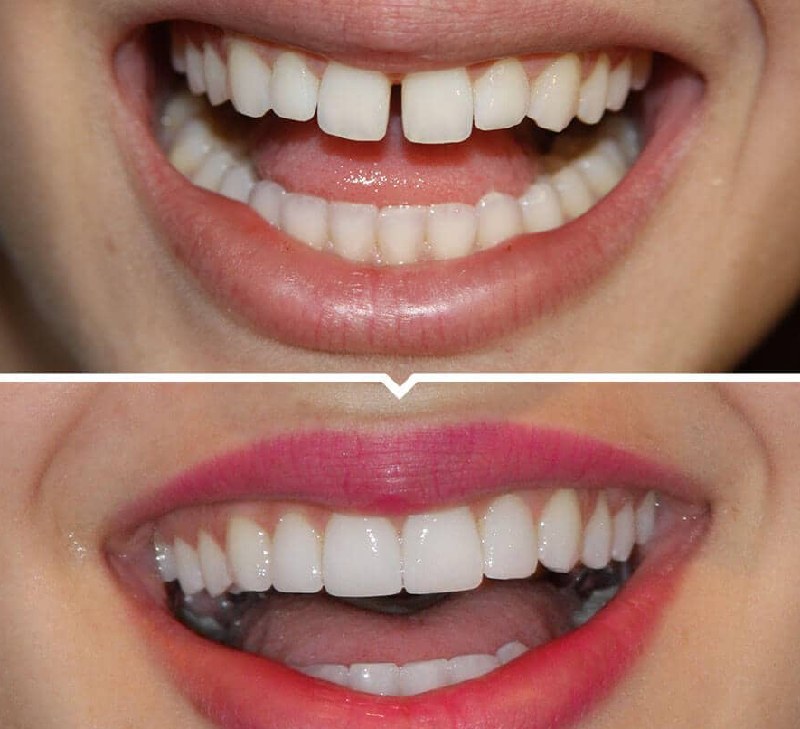 Một số trường hợp bọc răng sứ mang lại hiệu quả cao