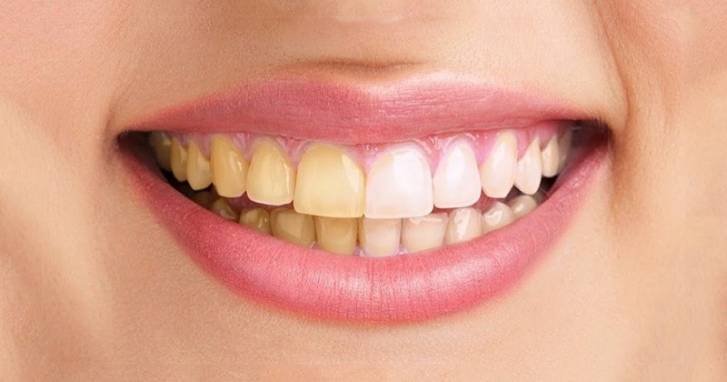 Cao răng không được lấy định kỳ là nguyên nhân gây bệnh nha chu