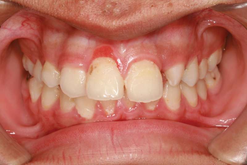 Tìm hiểu về bệnh viêm lợi - nướu chân răng