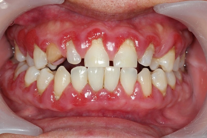 Chân răng và lợi có khoảng trống