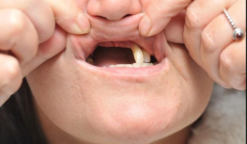 Khi không được can thiệp sớm, viêm lợi răng có thể gây ra nhiều hệ lụy xấu