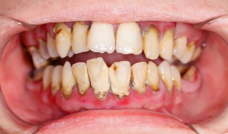 Vệ sinh răng miệng thiếu sạch sẽ có thể là nguyên nhân gây bệnh