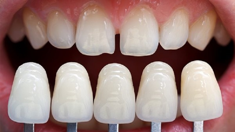 Kỹ thuật bọc răng sứ không cần mài răng nhiều giúp bảo tồn răng thật tốt hơn