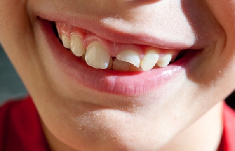 Người bị sứt mẻ răng có thể thực hiện bọc răng sứ không kim loại nếu có điều kiện