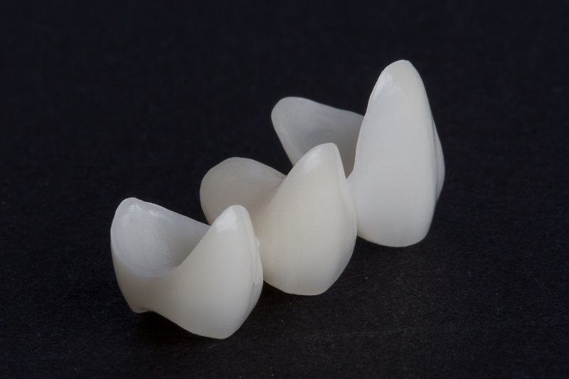 Răng toàn sứ mang tính thẩm mỹ cao và an toàn với sức khỏe răng miệng