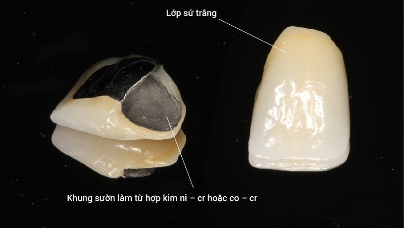 Cấu tạo của loại răng sứ kim loại
