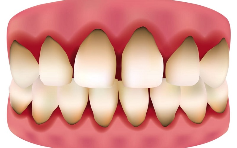 Răng sẽ bị đen chân nướu sau một thời gian dài sử dụng