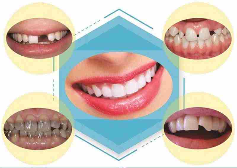 Bọc răng sứ giúp hàm răng trở nên đều và đẹp hơn
