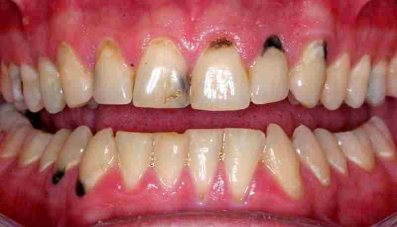 Tình trạng răng sâu quá nhiều có thể phục hình răng bằng cách bọc sứ