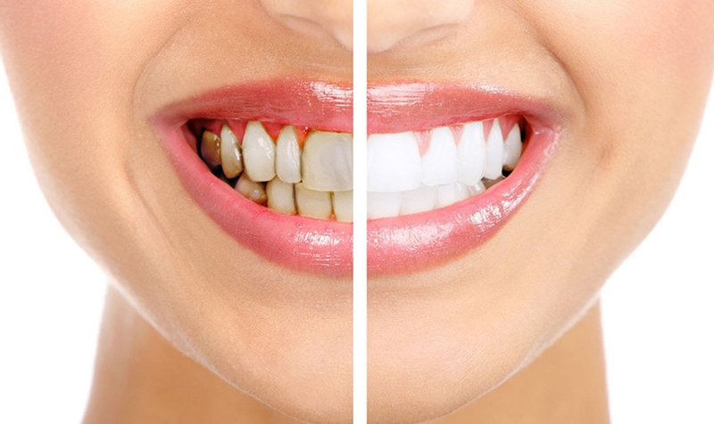 Răng bị ố vàng, xỉn màu cũng nên phục hình răng để có hàm răng trắng đẹp hơn
