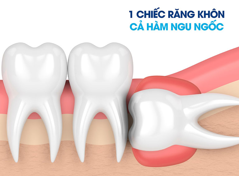 địa chỉ nhổ răng khôn quận 8 tốt