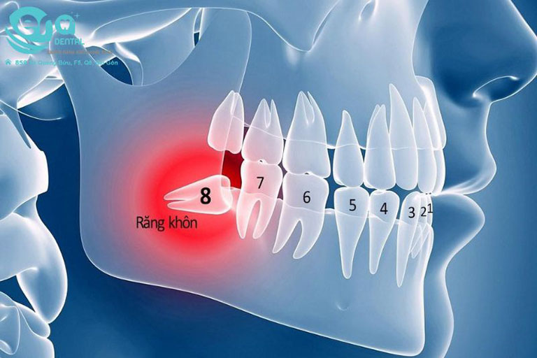 địa chỉ nhổ răng khôn quận 8 ít đau