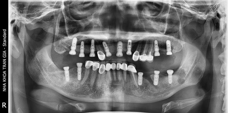 nha khoa trồng răng implant ở Tân Phú an toàn