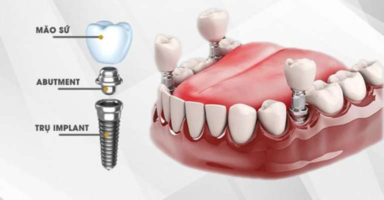 nha khoa trồng răng implant tại Tân Phú