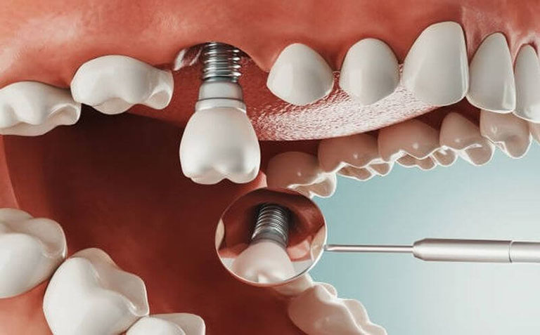 nha khoa trồng răng implant ở quận Tân Phú 