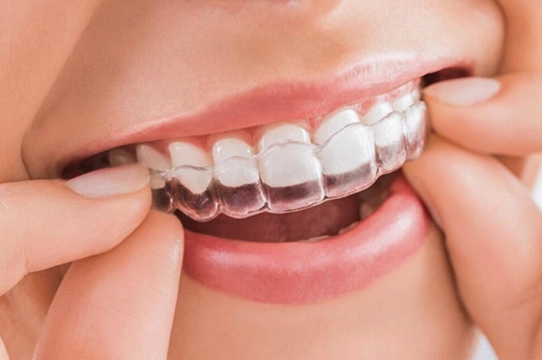 Niềng răng Invisalign