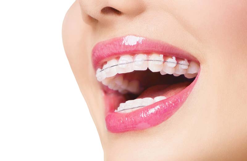 Thời gian niềng răng phụ thuộc vào tình trạng răng