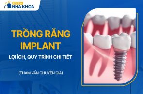 trồng răng implant