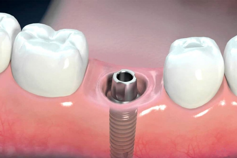 Đặt trụ Implant