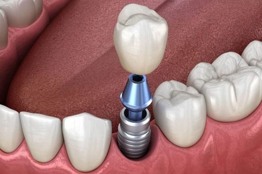 Cấy ghép Implant: Giảm 20% cho 10 suất