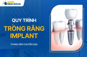 Quy trình trồng răng Implant